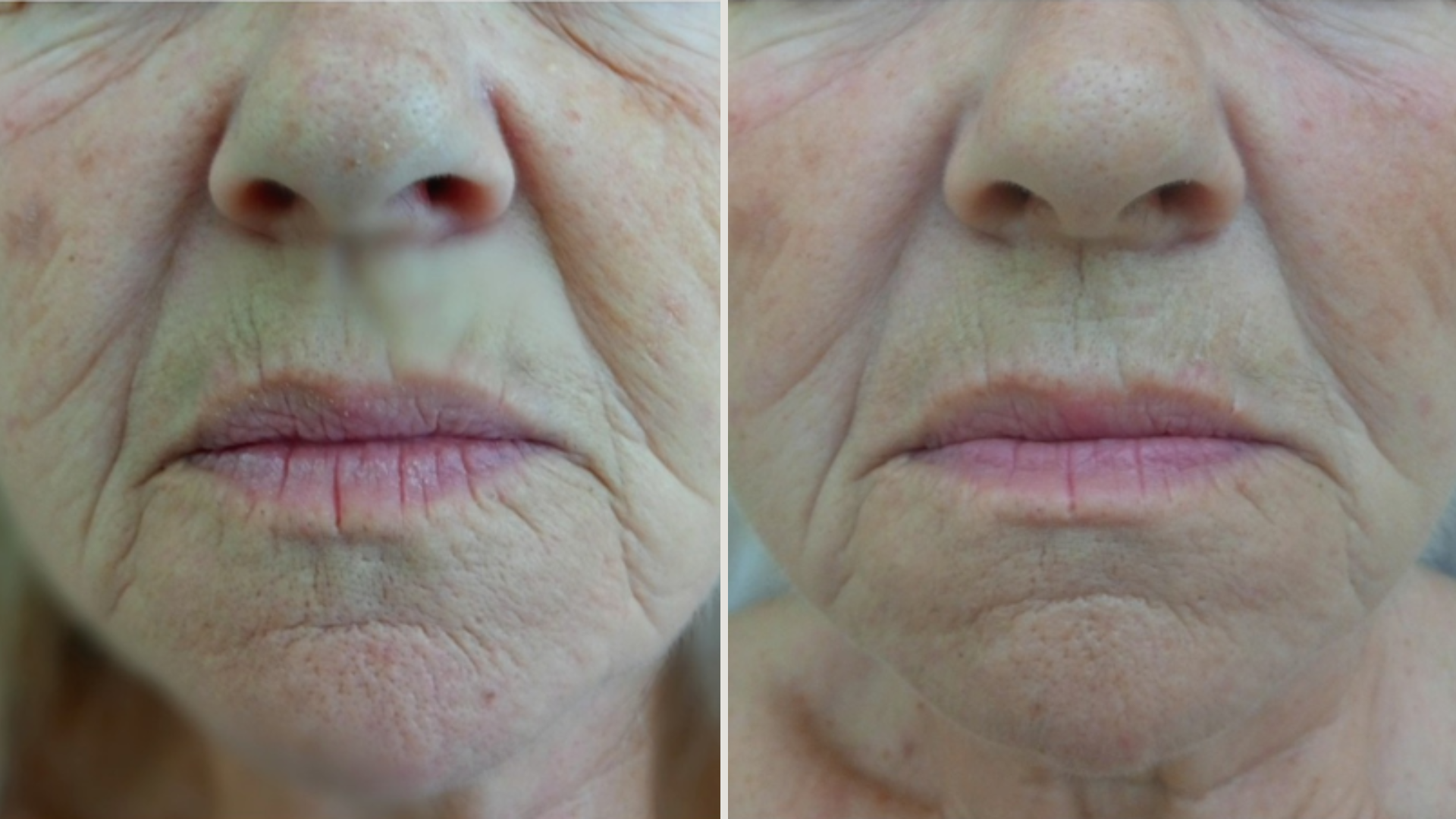 Лифтинг и изглаждане на кожата — преди и след